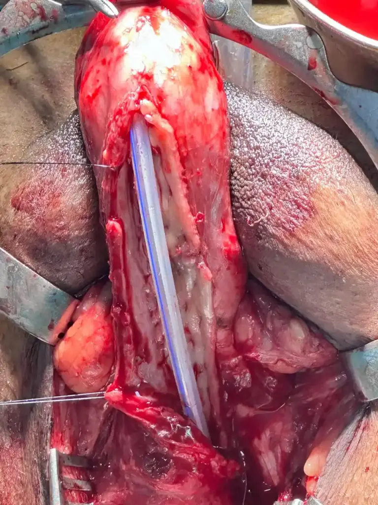 buccal mucosa urethroplasty in indore