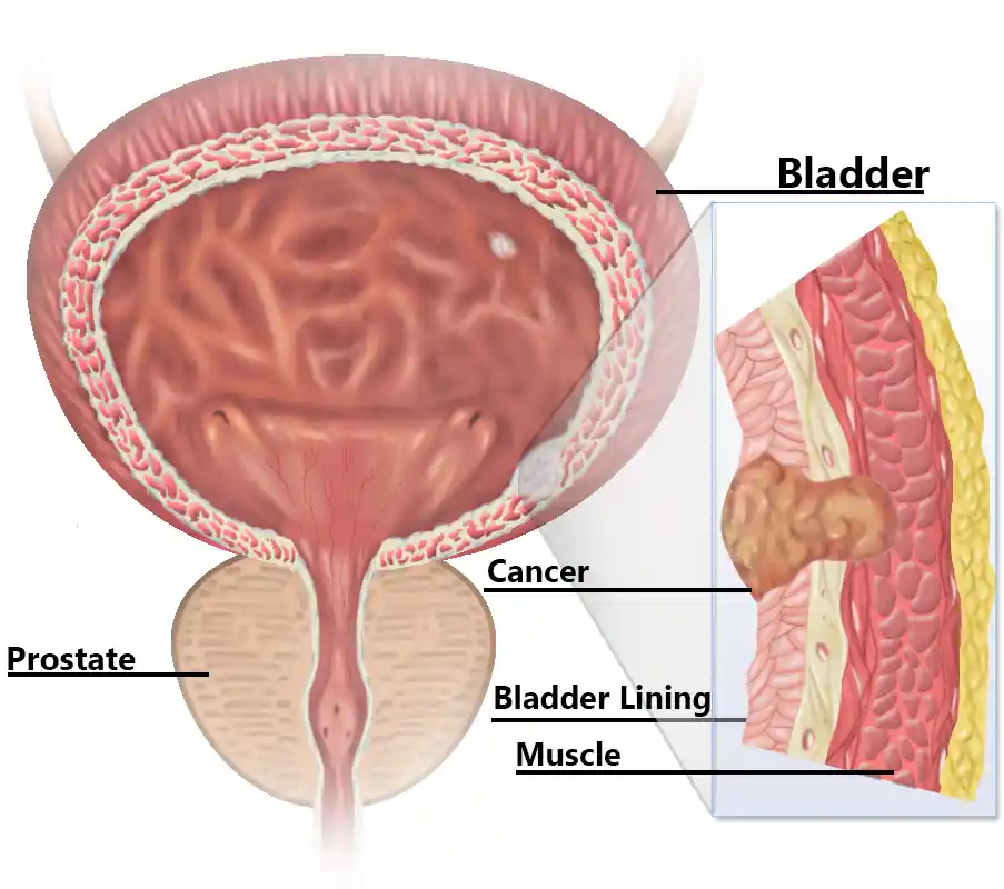 bladder prostate treatment in indore