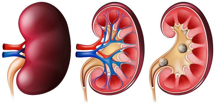 kidney stone surgery in indore
