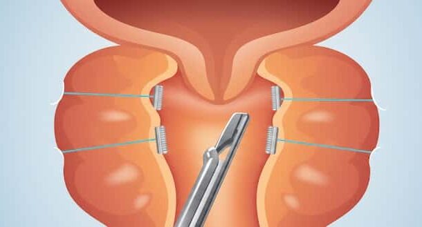 urolift prostate surgery in indore