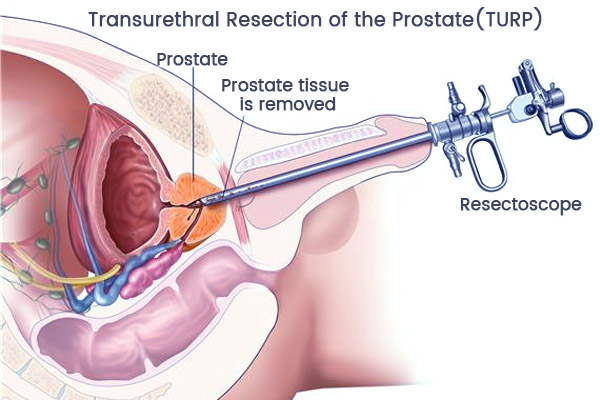 best laser prostate surgery in indore