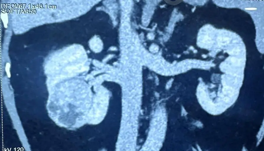 renal cancer treatment in indore