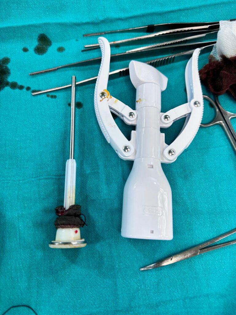 stapler circumcision in indore