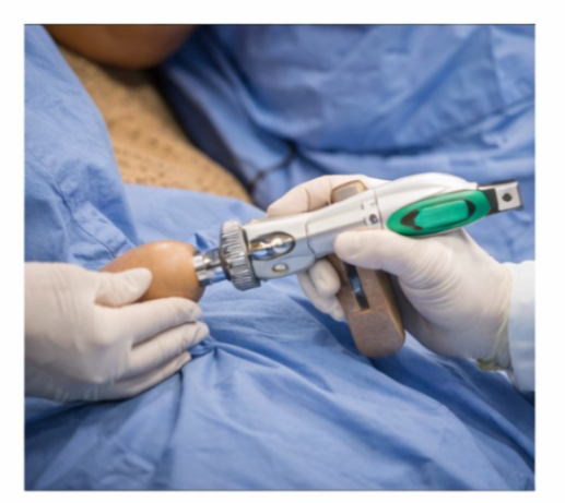 stapler circumcision in Indore