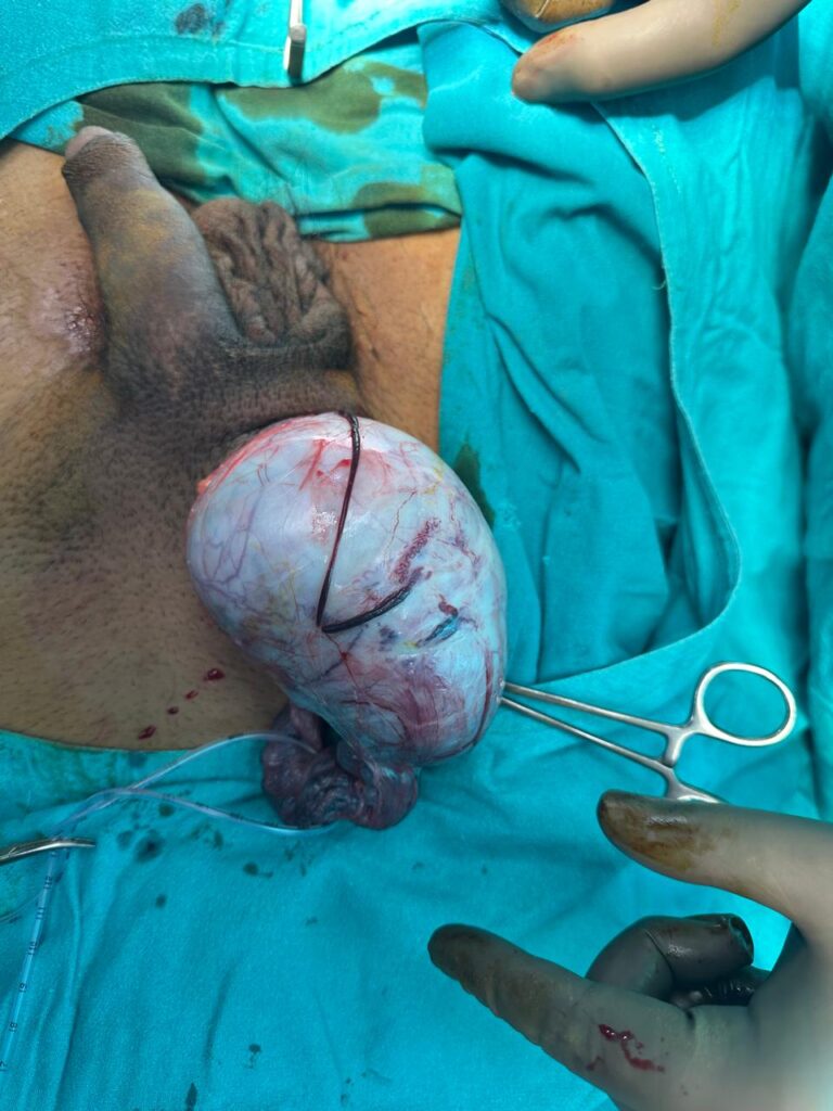 testicular cancer treatment in indore