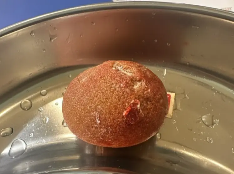 bladder stone surgery in indore