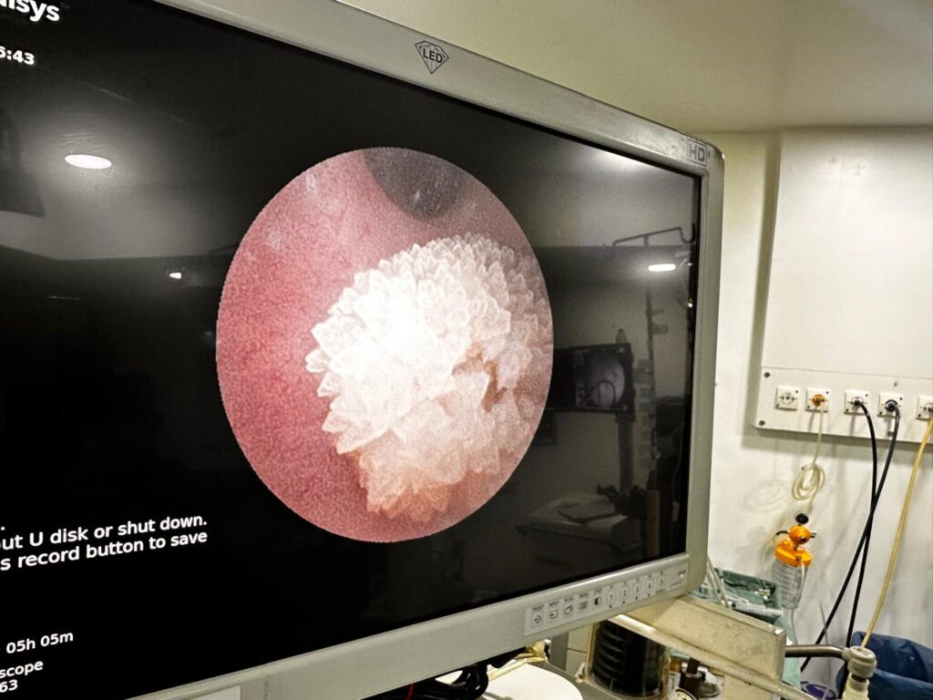 retrograde intrarenal surgery in indore